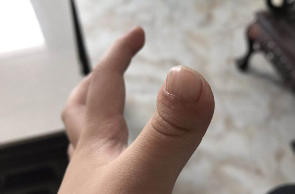断指复原的背后是医疗技术还是佛法力量？-图片6